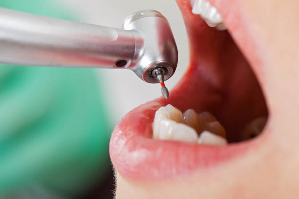 Best Emergency Root Canal Treatment in Seymour, IN